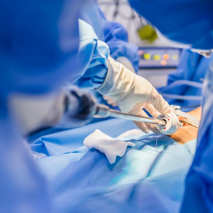 Surgeon or doctor in blue gown put medical instrument or device at camera portal during laparoscopic cholecystectomy inside operating room.Keyhole surgery technology in obesity surgical treatment.